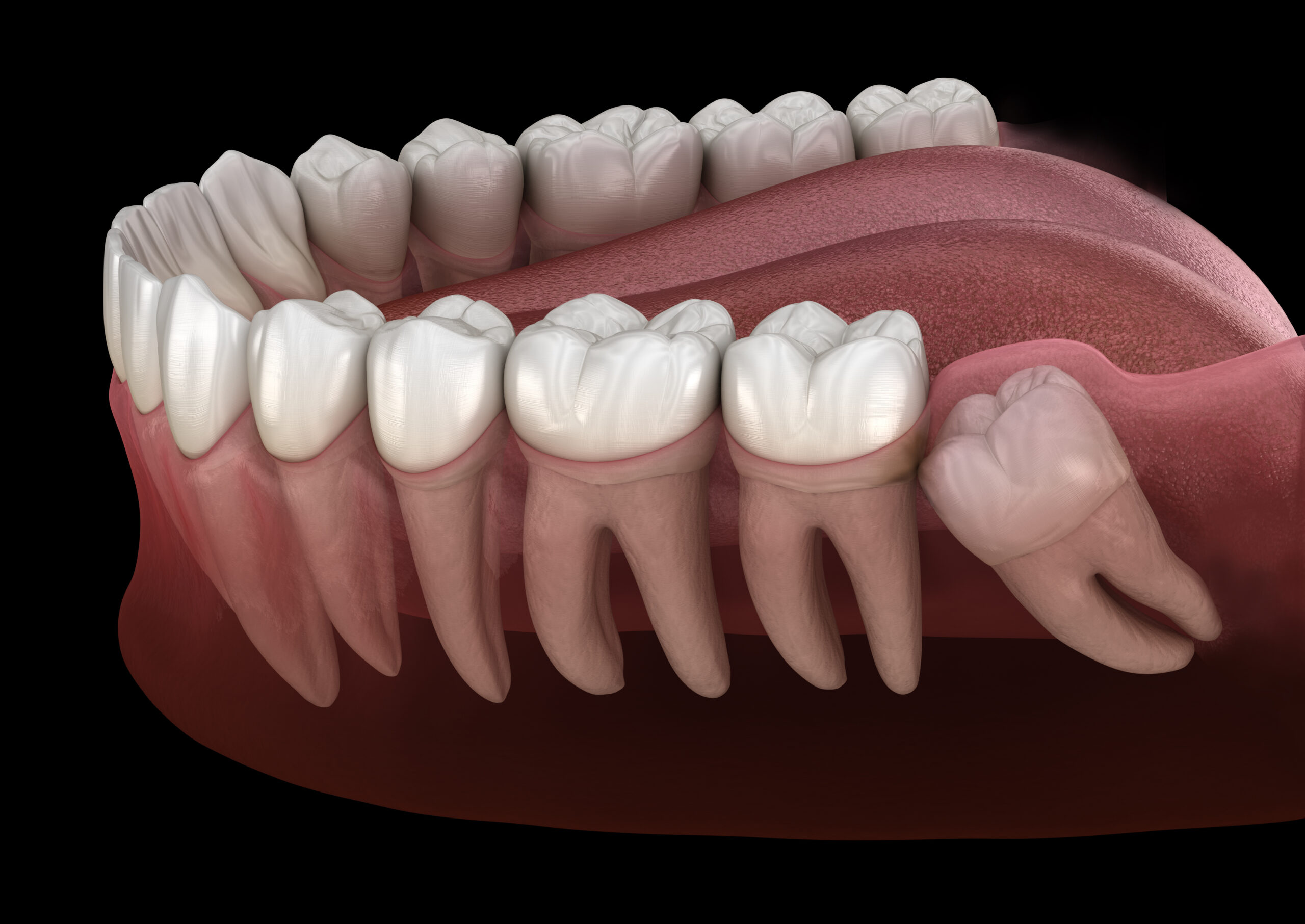 The Importance of Wisdom Teeth Removal