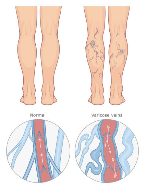 Treating Varicose Vein Disease